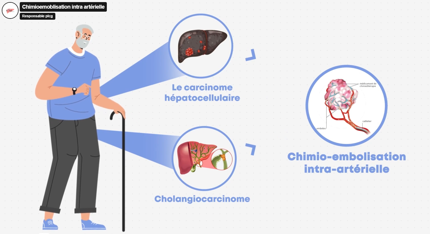 /images/Chimioembol.png